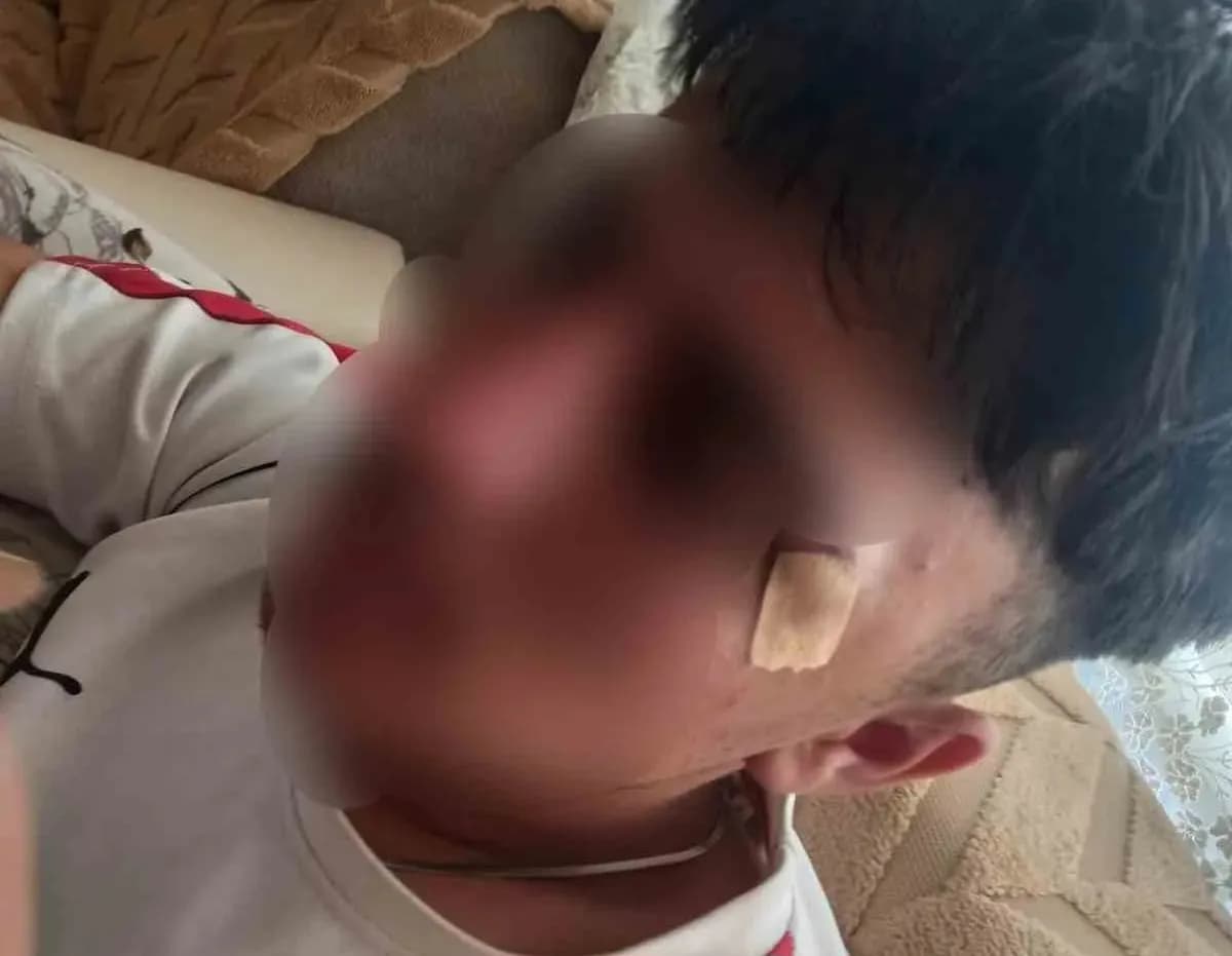 Öğretmenin kafa attığı çocuğun burnu kırıldı